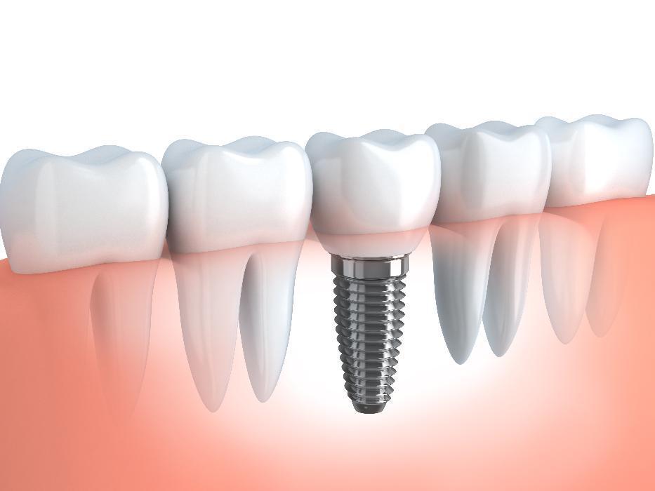 Dental Implants | Mill Creek Dental Health Care | Mill Creek, WA
