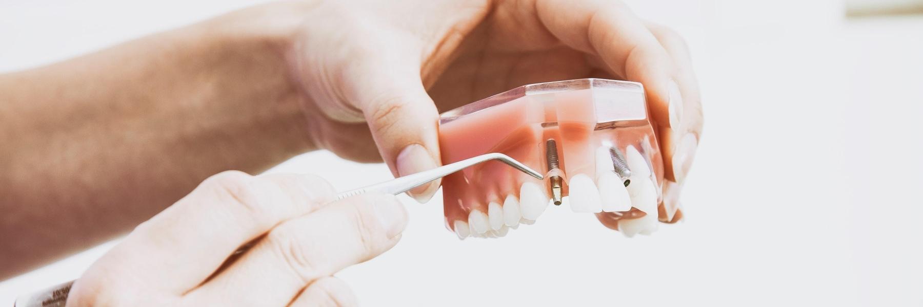 Model that shows how dental implants work